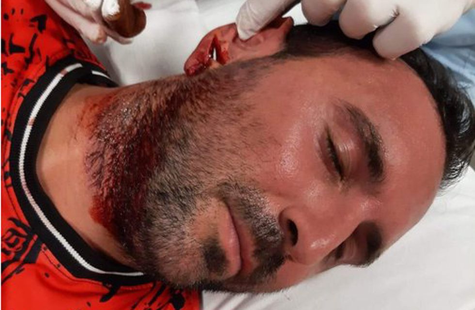 Feroz agresión en una Liga del interior cordobés: un jugador mordió en la oreja a un rival, terminó en el hospital | Canal Showsport